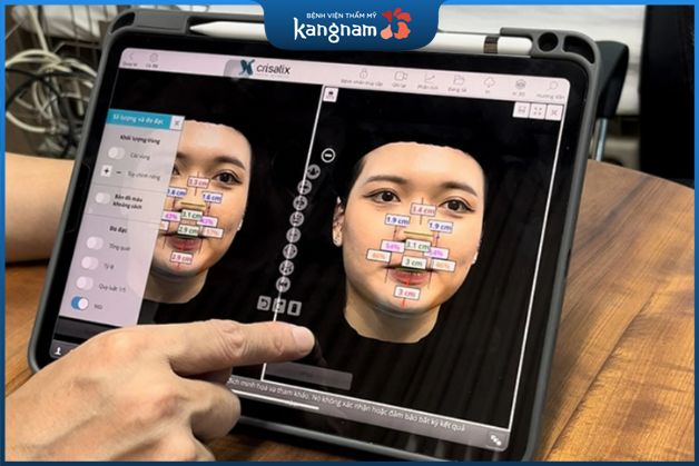 Sử dụng AI Face Design khi nâng mũi 6D Surgiform