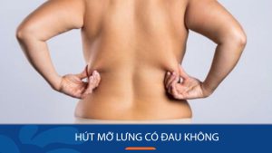 Hút mỡ lưng có đau không? – Không đau nhanh lành gấp 3 lần tại Kangnam