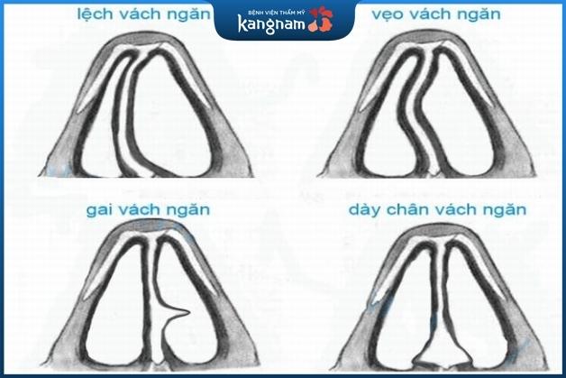 Vách ngăn mũi bị cong vẹo theo nhiều dạng