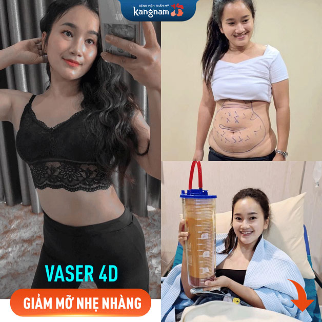 Khách hàng hút mỡ và tạo hình thành bụng