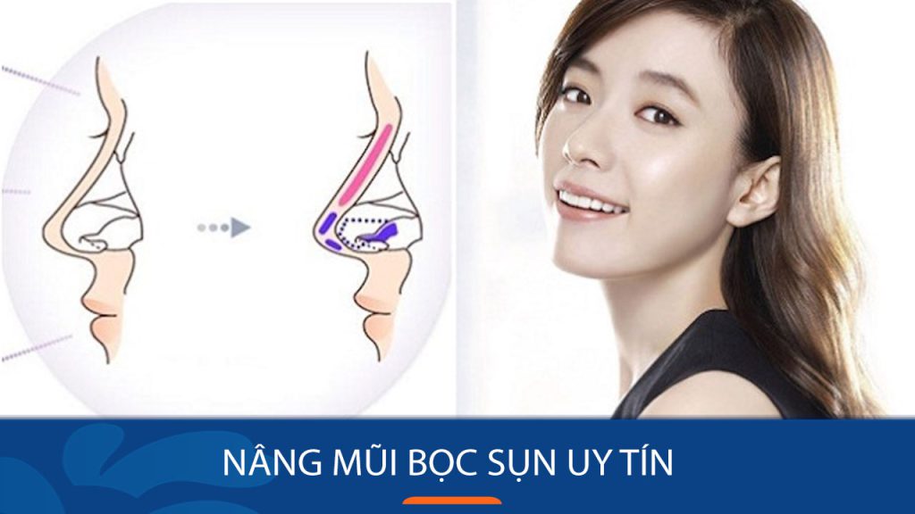 Nâng mũi bọc sụn uy tín ở đâu? Bác sĩ Vũ Minh Tân trả lời