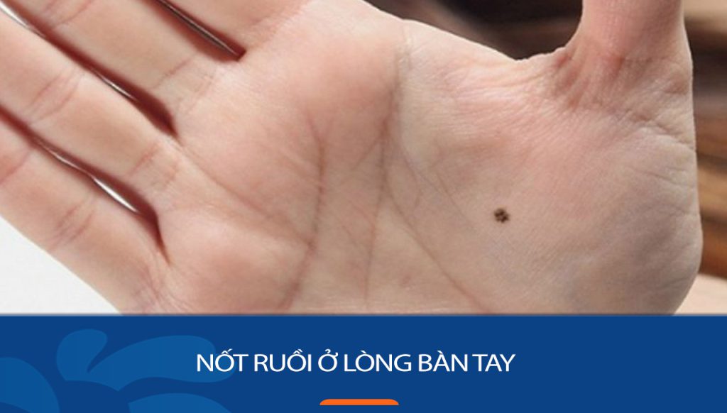 Nốt ruồi trong lòng bàn tay: Bí ẩn về số phận & vận mệnh được giải mã