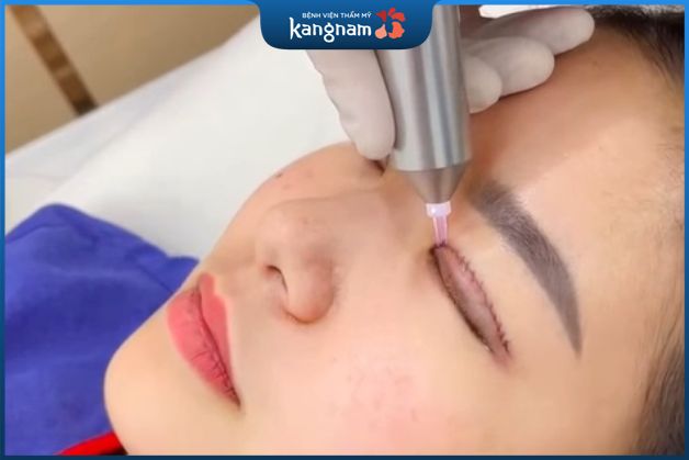 Sử dụng công nghệ Plasma trong cắt mí mắt