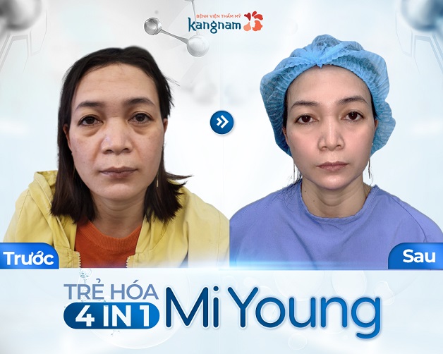 Chị Hiền 45 tuổi lấy lại 10 tuổi sau khi trẻ hóa da tại Kangnam