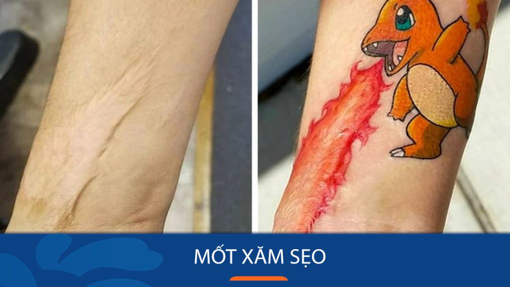 “Mốt xăm sẹo” thú chơi mới kỳ dị của giới trẻ