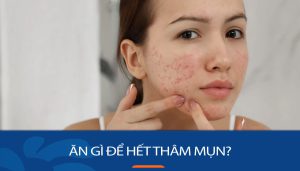 Chuyên gia da liễu tư vấn: Ăn gì để hết thâm mụn?