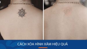 Cách xóa hình xăm hiệu quả nhanh và an toàn không để lại sẹo