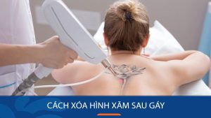 Giải đáp: Cách xóa hình xăm sau gáy an toàn hiệu quả nhất