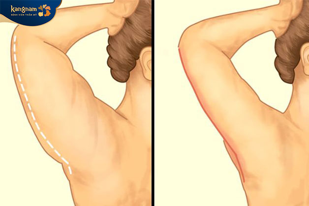 Căng da cho vùng da dưới cánh tay là gì?