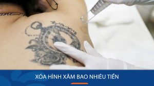 Chi phí xóa hình xăm bao nhiêu tiền? Các yếu tố ảnh hưởng tới giá