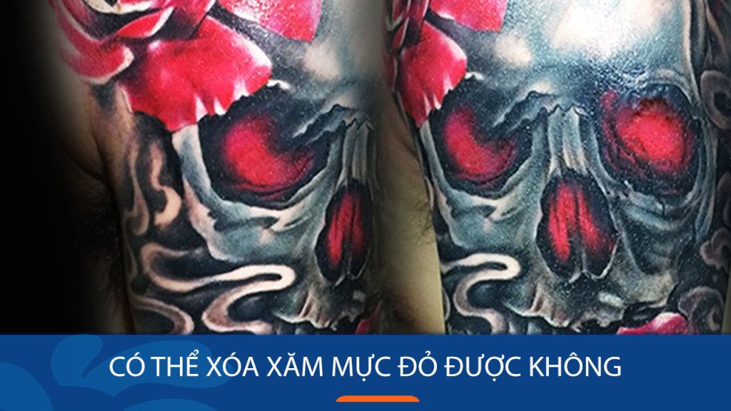 Có thể xóa xăm mực đỏ được không: Bác sĩ kangnam giải đáp