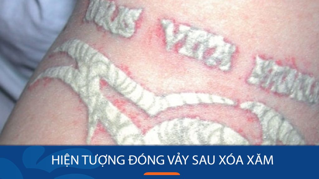 Tại sao lại có hiện tượng đóng vảy sau xóa xăm?