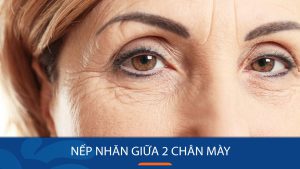 Bí quyết xóa nếp nhăn giữa 2 chân mày nhanh chóng