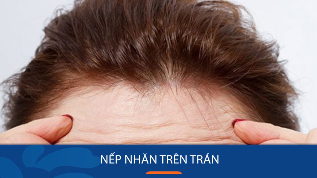 Nếp nhăn trên trán: “Kẻ thù” của tuổi trẻ – Bí quyết đánh bay hiệu quả