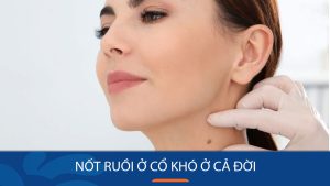 Nốt ruồi ở cổ: “Tai họa” hay “Phúc lộc”? Nên giữ hay nên tẩy?