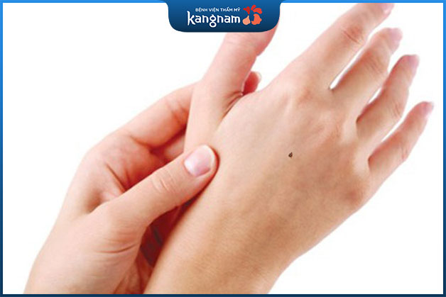 Nam giới và nữ giới sở hữu nốt ruồi trên mu bàn tay phải đều mang điềm không may