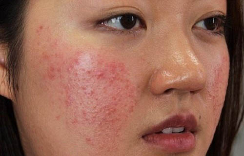 Tẩy lông mặt bằng mỡ trăn không đúng cách có thể gây hại cho da