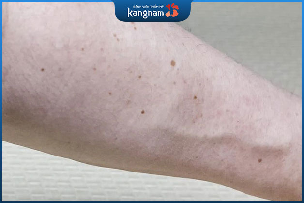 Nốt ruồi xuất hiện nhiều trên tay không hề gây hại cho sức khỏe
