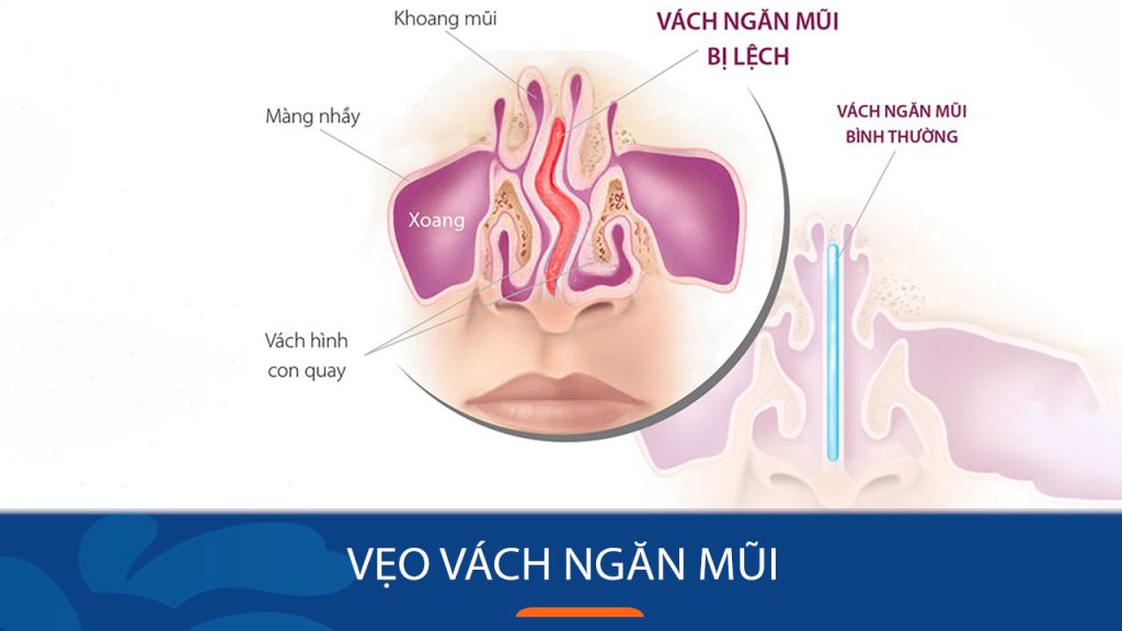 Vẹo vách ngăn mũi – Nguy hiểm tiềm ẩn và giải pháp điều trị