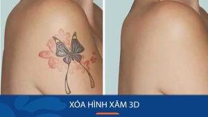 Xóa hình xăm 3D dễ hay khó công nghệ xóa xăm 3D