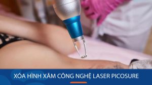 Xóa hình xăm công nghệ Laser Picosure – Tẩy xăm nhanh chóng