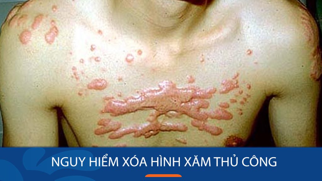 Rùng mình với những phương pháp xóa hình xăm thủ công