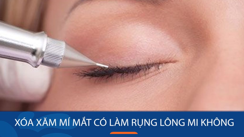 Xóa xăm mí mắt có làm rụng lông mi không? Bác sĩ kangnam chia sẻ