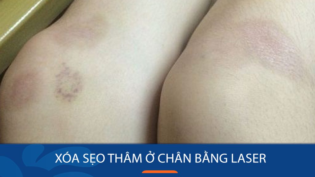 Xóa sẹo thâm ở chân vĩnh viễn bằng Laser: Bí quyết lấy lại làn da mịn màng
