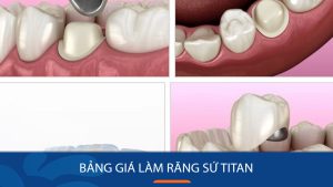 Bảng giá làm răng sứ titan – Có nên chọn răng sứ giá rẻ?