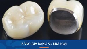 Bảng giá răng sứ kim loại cập nhật mới nhất tại Kangnam