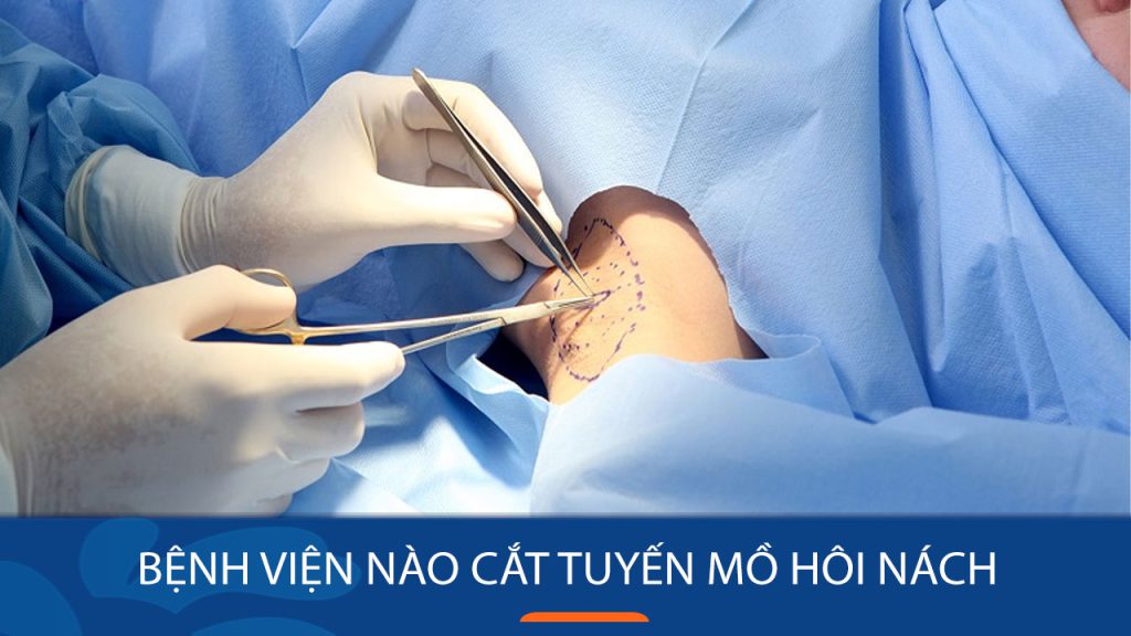 Bệnh viện nào cắt tuyến mồ hôi nách hiệu quả dứt điểm?