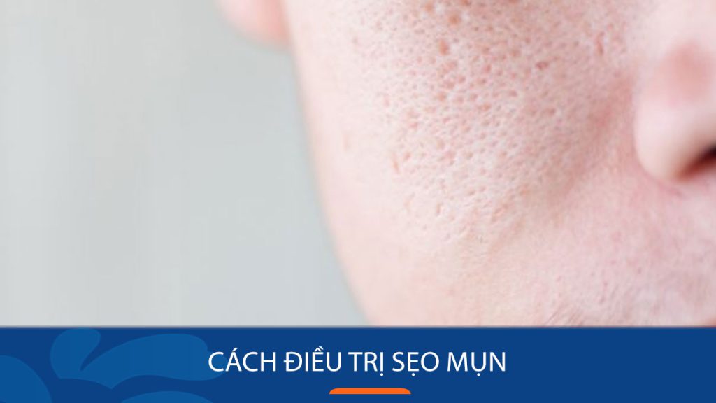 9 Cách Điều Trị Sẹo Mụn Hiệu Quả Nhất 2025