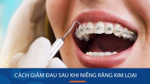 13 Cách giảm đau sau khi niềng răng kim loại hiệu quả