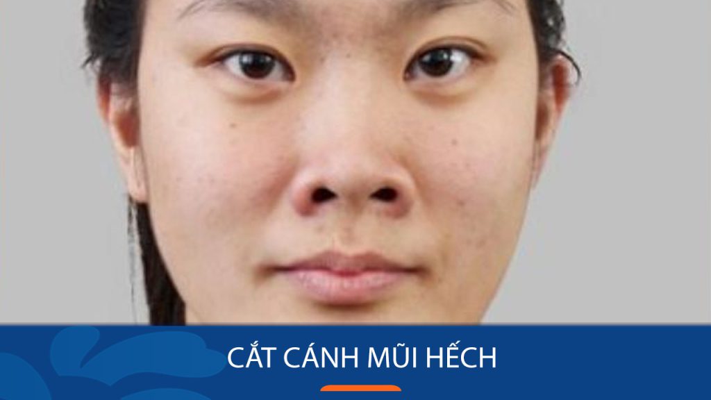 Cắt cánh mũi hếch: Bí quyết sở hữu dáng mũi thon gọn, thanh tú