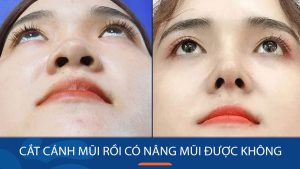 Cắt cánh mũi rồi có nâng mũi được không? Giải đáp thắc mắc từ A đến Z