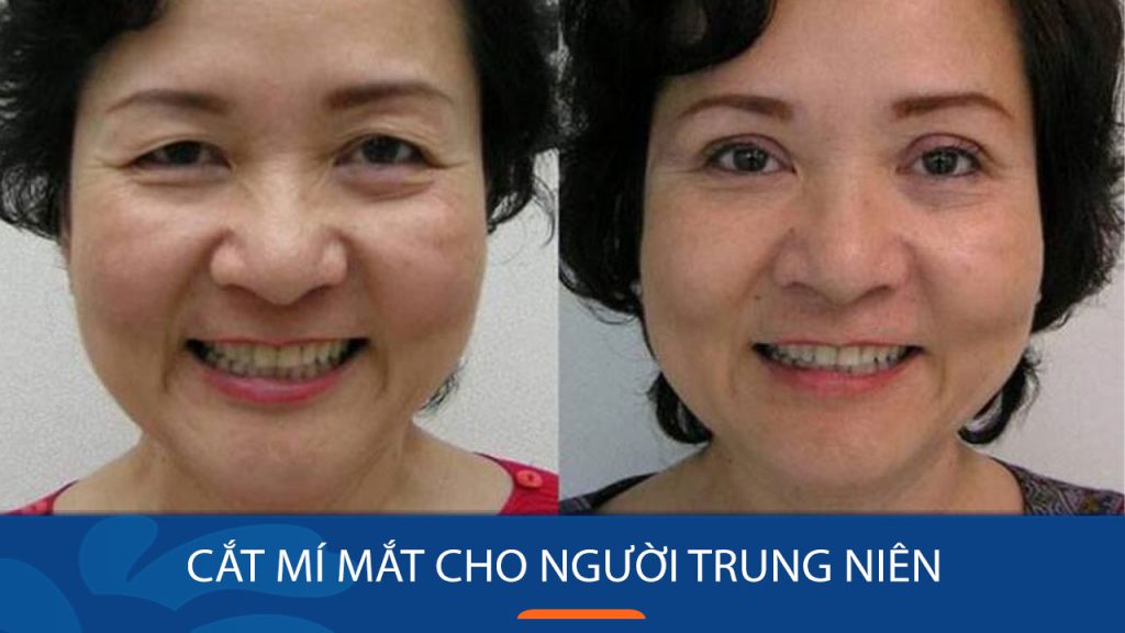 Cắt mí mắt cho người trung niên: Hỏi đáp với bác sĩ Kangnam