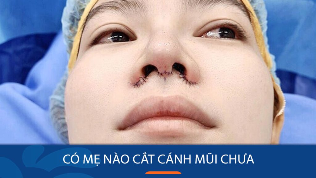 Có mẹ nào cắt cánh mũi chia sẻ kinh nghiệm không?