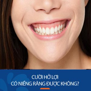 Cười hở lợi có niềng răng được không? Kangnam giải đáp