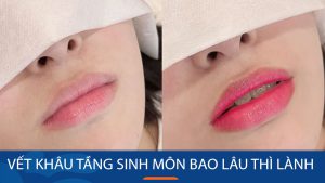 Feedback phun môi trước và sau khi bong tại Kangnam