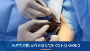 Có nên hút tuyến mồ hôi nách? Giải đáp thắc mắc về công nghệ 5.0