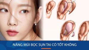 Nâng mũi bọc sụn tai có tốt không? Giải đáp từ bác sĩ Kangnam