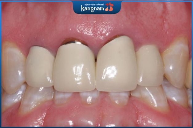 Răng sứ kim loại thường và răng sứ Titan đều có những ưu và nhược điểm riêng