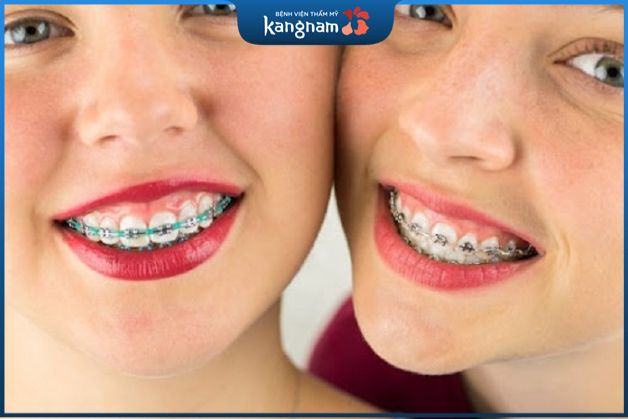 cười hở lợi có chữa được bằng niềng răng hay không còn tùy thuộc vào tình trạng răng miệng mỗi người