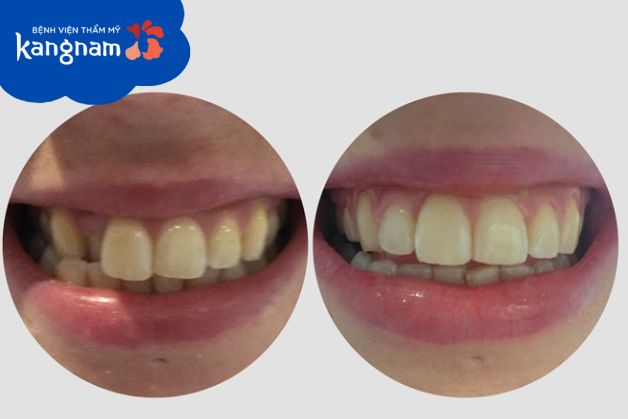 Niềng răng mắc cài pha lê cải thiện mọi tình trạng từ nhẹ đến nặng