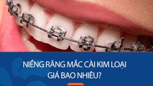 Niềng răng mắc cài kim loại thường giá bao nhiêu? 5 Yếu tố ảnh hưởng