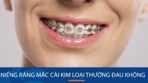 Niềng răng mắc cài kim loại thường có đau không?Bác sĩ kangnam giải đáp