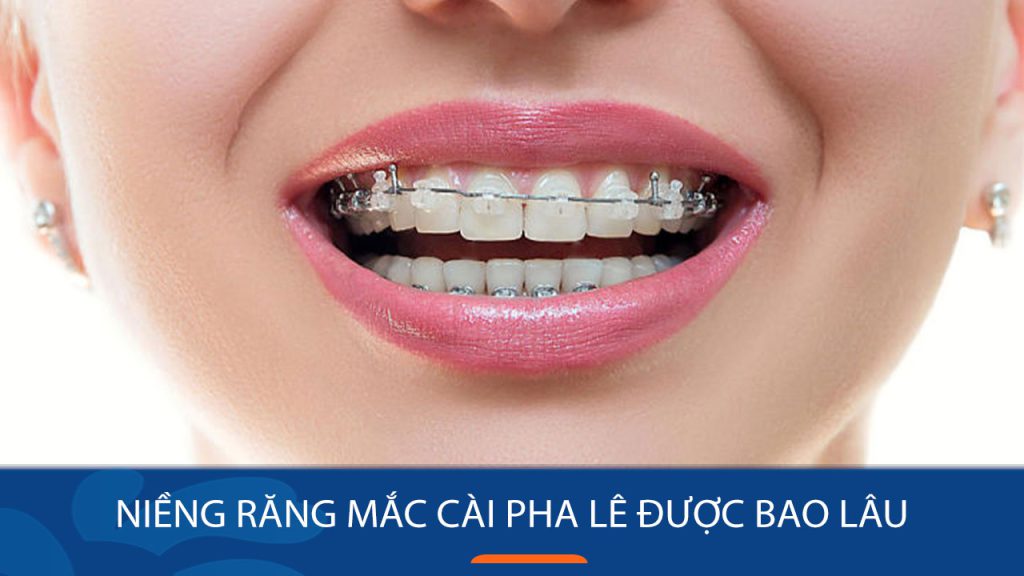 Niềng răng mắc cài pha lê được bao lâu? 4 ưu điểm vượt trội