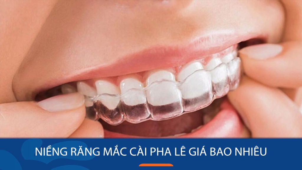 Niềng răng mắc cài pha lê giá bao nhiêu? Những lưu ý quan trọng