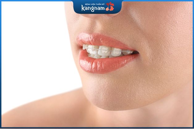 Niềng răng mắc cài pha lê là phương pháp chỉnh nha hiện đại