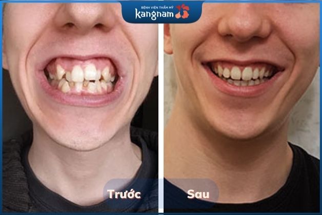 Niềng răng cải thiện răng sai lệch và giảm hở lợi